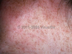 Clinical image of Reticulate pigmented anomaly of flexures - imageId=2722751. Click to open in gallery.  caption: 'Multiple light brown macules on the lateral neck.'