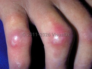 Scleroderma