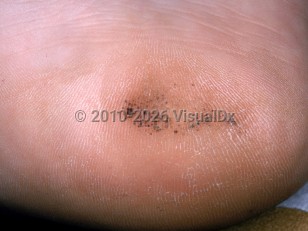 Clinical image of Talon noir - imageId=2724295. Click to open in gallery.  caption: 'A light brown patch with black and gray peppering on the heel.'