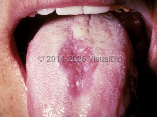 Median rhomboid glossitis