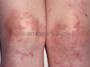 Polyarteritis nodosa
