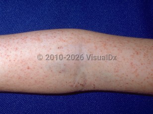 Rocky Mountain spotted fever