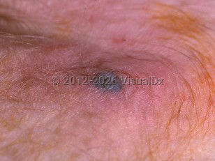 Bacterial sepsis