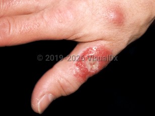 Mycobacterium marinum infection