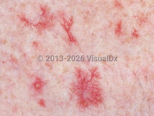 Telangiectasia