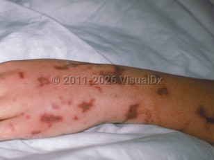 Purpura fulminans