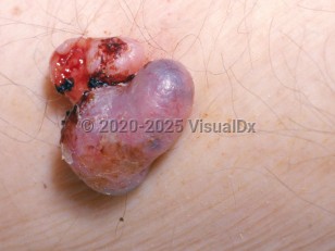 Clinical image of Eccrine gland carcinoma - imageId=2787649. Click to open in gallery.  caption: 'A close-up of an ulcerated and crusted, bilobed, exophytic, skin-colored and dusky pink nodule.'