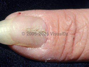 Median nail dystrophy