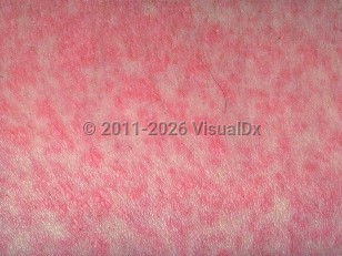 Viral exanthem