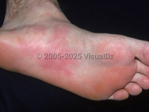 Pressure urticaria