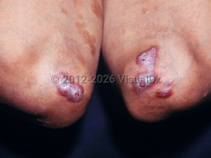 Erythema elevatum diutinum