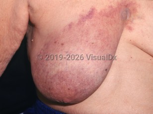 Cutaneous presentations of breast cancer