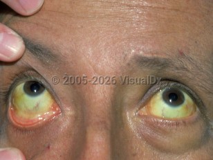 Drug-induced jaundice