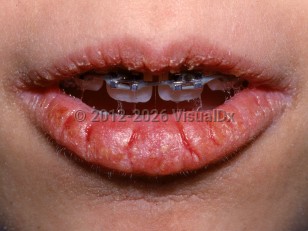 Cheilitis