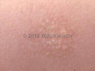 Alopecia mucinosa