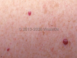 Cherry hemangioma