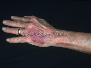 Solar purpura