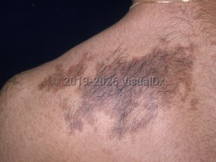 Becker nevus