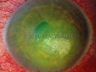 Drug-induced corneal deposits