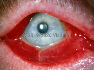 Ophthalmic Imaging image of Acute hemorrhagic conjunctivitis - imageId=2842429. Click to open in gallery.  caption: 'Extensive conjunctival hemorrhage.'