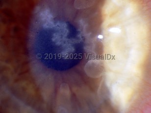Herpes simplex virus keratitis
