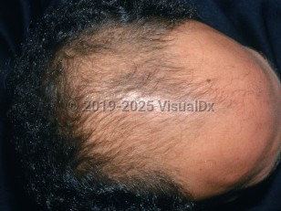 Male pattern alopecia