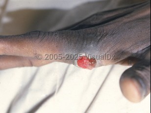 Bacillary angiomatosis