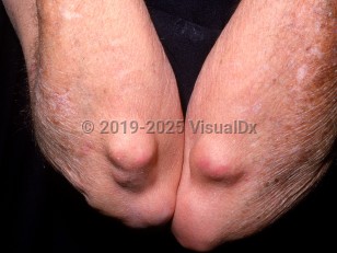 Rheumatoid nodule