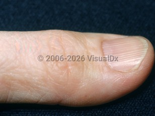 Longitudinal nail ridging