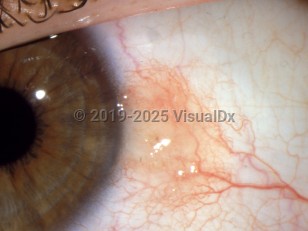 Conjunctival nevus