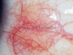 Diffuse episcleritis