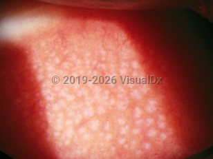 Giant papillary conjunctivitis