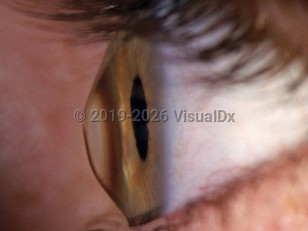 Ophthalmic Imaging image of Keratoconus - imageId=2894408. Click to open in gallery. 