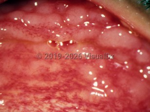 Follicular conjunctivitis