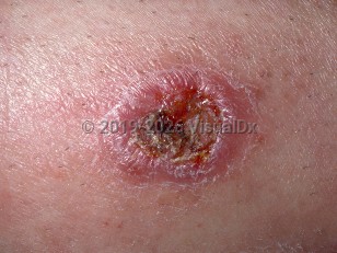 Cutaneous leishmaniasis