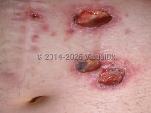 Cutaneous amebiasis