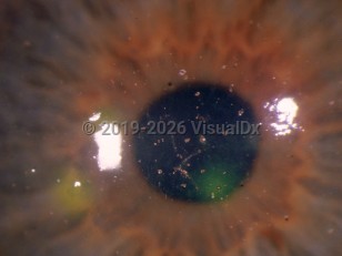 Corneal abrasion