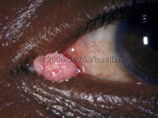 Conjunctival papilloma