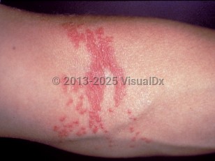 Clinical image of Jellyfish sting - imageId=292160. Click to open in gallery.  caption: 'Edematous, erythematous papules and plaques in linear arrays at the antecubital fossa following a lion's mane jellyfish sting.'