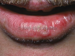 Actinic cheilitis