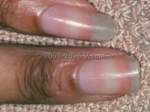 Nail changes of chronic renal failure