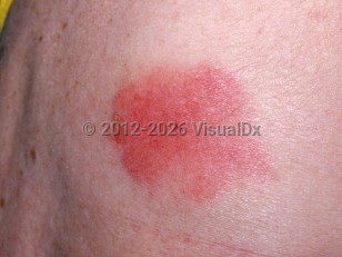 Bumblebee sting