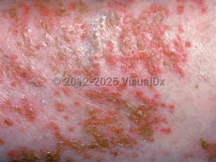 Clinical image of Glucagonoma syndrome - imageId=2949314. Click to open in gallery.  caption: 'A close-up of many crusted papules.'