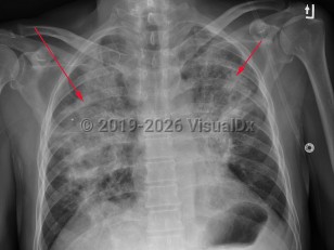Imaging Studies image of Herpes simplex virus pneumonia - imageId=2953740. Click to open in gallery.  caption: 'Frontal chest x-ray with bilateral air space consolidation, right lobe, (long red arrow),&nbsp;greater than left, (short red arrow).'