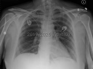 Pulmonary embolism