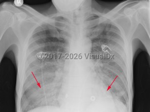 Pneumocystis jirovecii pneumonia