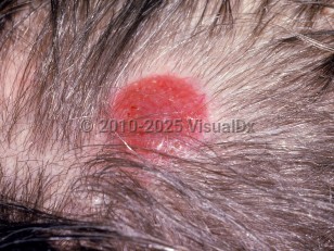 Alopecia neoplastica
