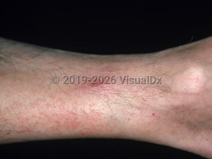 Phlebitis