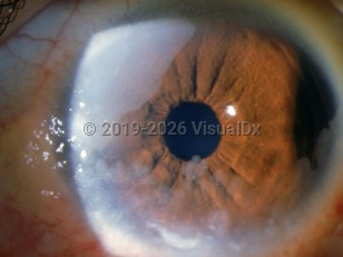 Corneoconjunctival squamous cell carcinoma