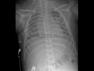 Imaging Studies image of Smoke inhalation - imageId=3014655. Click to open in gallery.  caption: 'Image from frontal chest x-ray in a child demonstrating bilateral, diffuse interstitial opacities, consistent with pulmonary edema. There is an endotracheal tube in the trachea, as well as an enteric tube extending into the duodenum.'